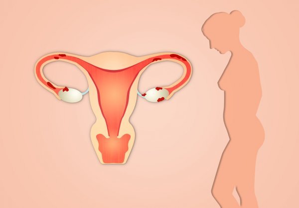 Essential Guide to Endometriosis